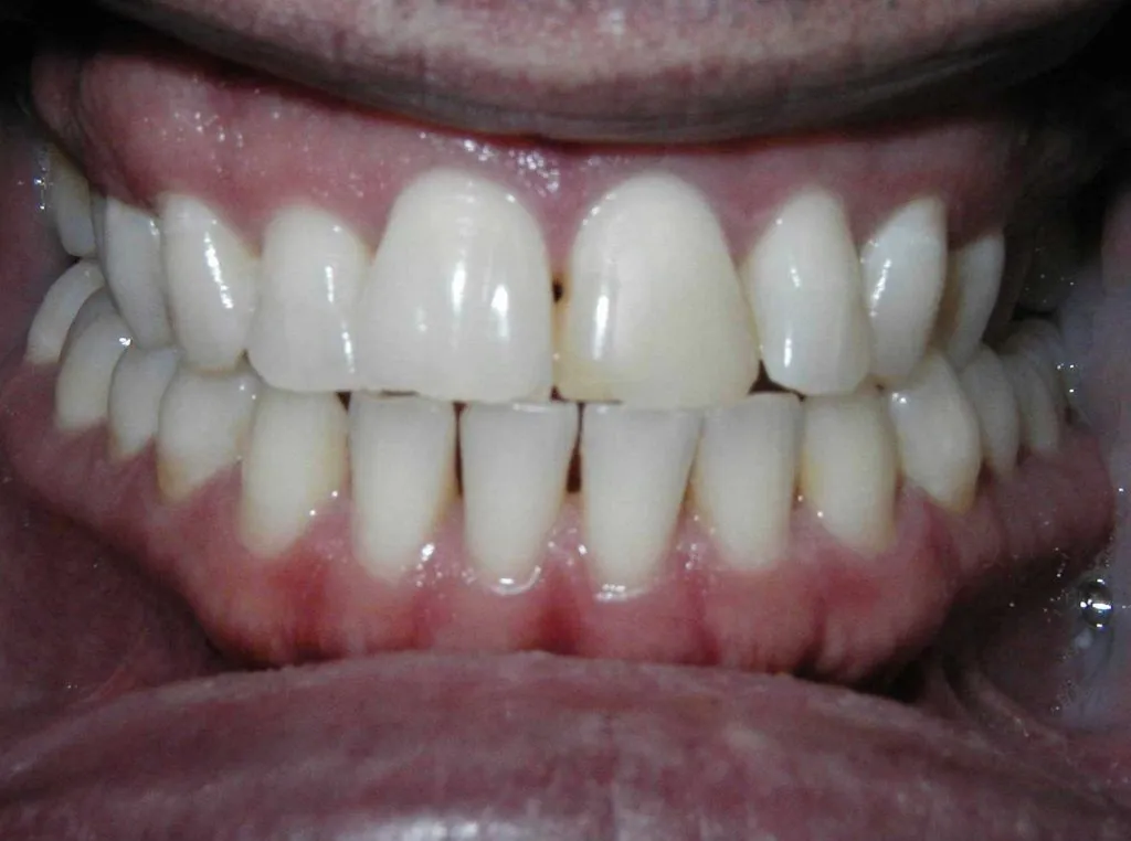 Gapped and slightly discoloured front teeth before cosmetic dentistry at Boca Dental