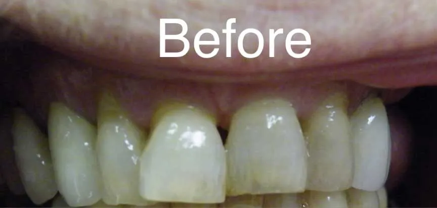 Discoloured and worn upper front teeth before treatment at Boca Dental in Boca Raton, FL