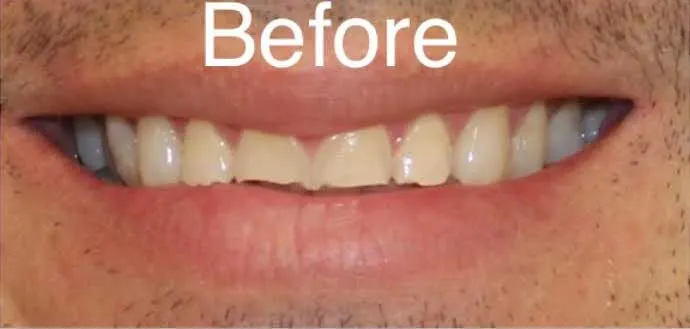Chipped and uneven front teeth before cosmetic treatment at Boca Dental
