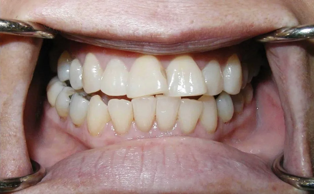 Inlays and Onlays | Cosmetic Dentist &amp; Dental Doctor in Boca Raton, FL | Call (561) 391-6606