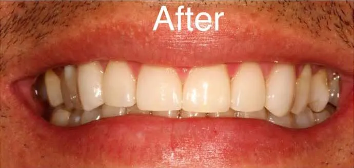 Straight, even smile after cosmetic treatment at Boca Dental