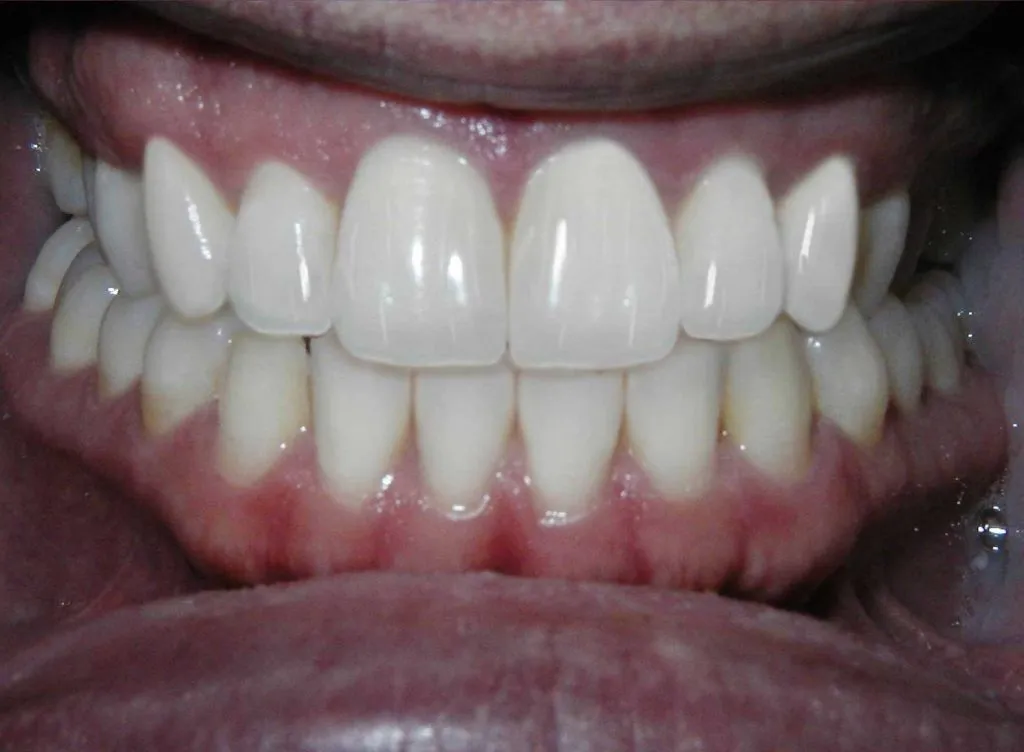 Inlays And Onlays | Cosmetic Dentist &amp; Dental Doctor, FL 33431