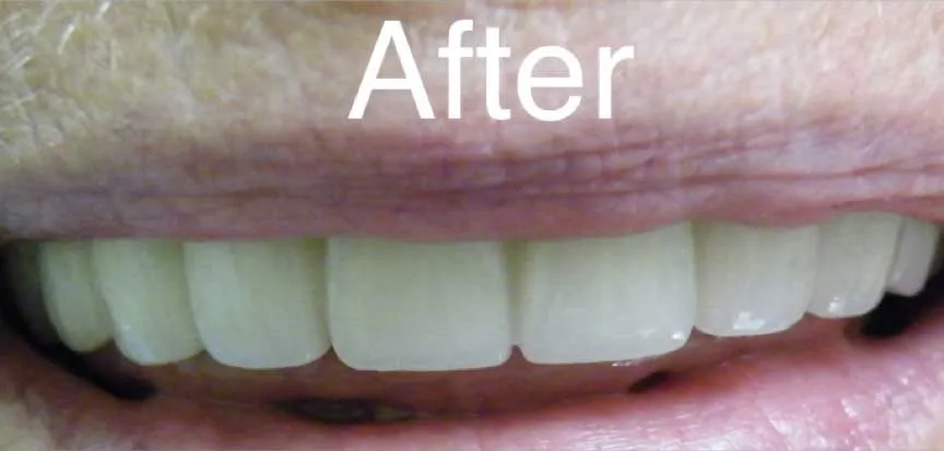 Teeth In A Day | Boca Dental Implants, FL | Call 561-391-6606