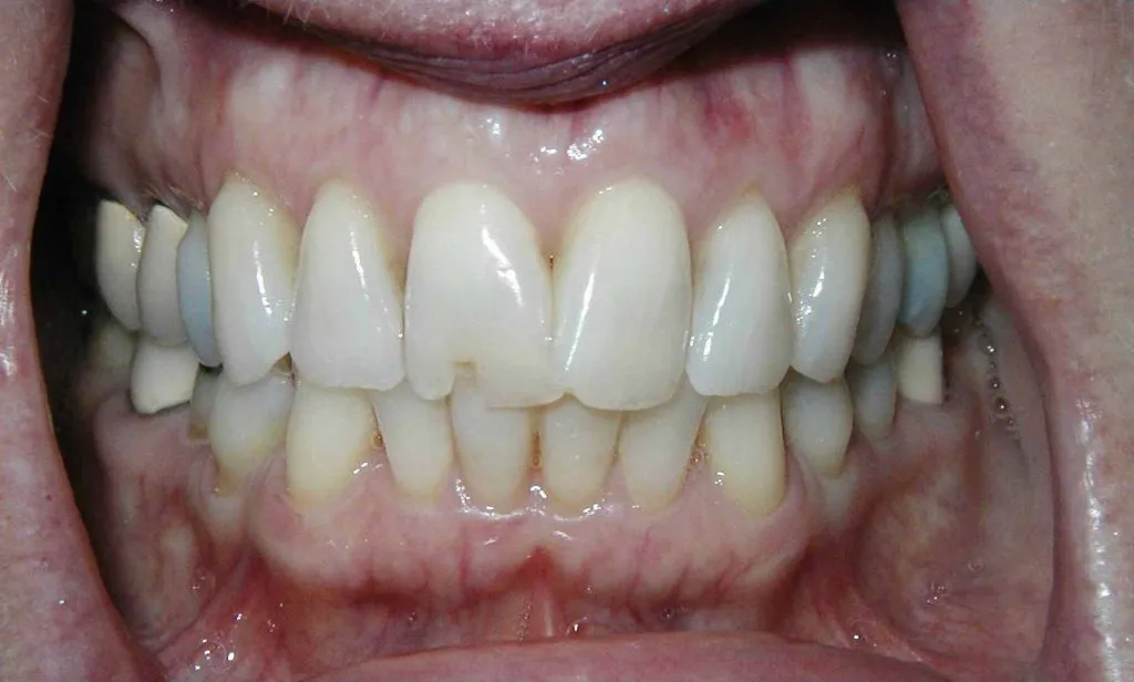Worn and chipped teeth with uneven edges before full mouth reconstruction at Boca Dental