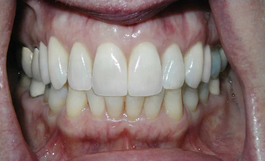 Inlays and Onlays | Cosmetic Dentist &amp; Dental Doctor in Boca Raton, FL | Call (561) 391-6606