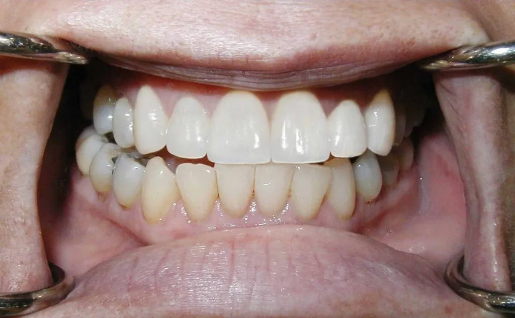 Inlays and Onlays | Cosmetic Dentist &amp; Dental Doctor in Boca Raton, FL | Call (561) 391-6606