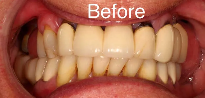 Worn, stained and receding teeth before full-mouth restoration at Boca Dental
