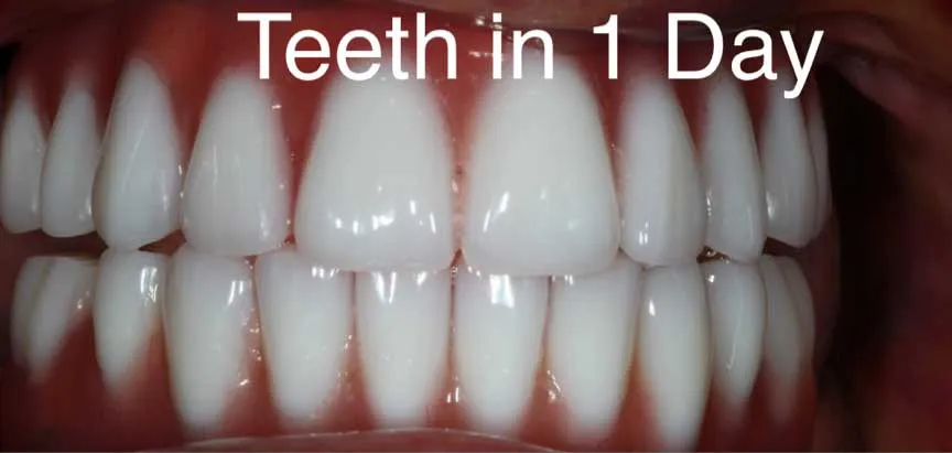 Complete, uniform white smile after Teeth In One Day treatment at Boca Dental