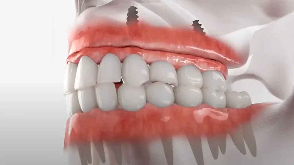 CEREC One-Day Crowns | Boca Raton, FL | Call (561) 391-6606