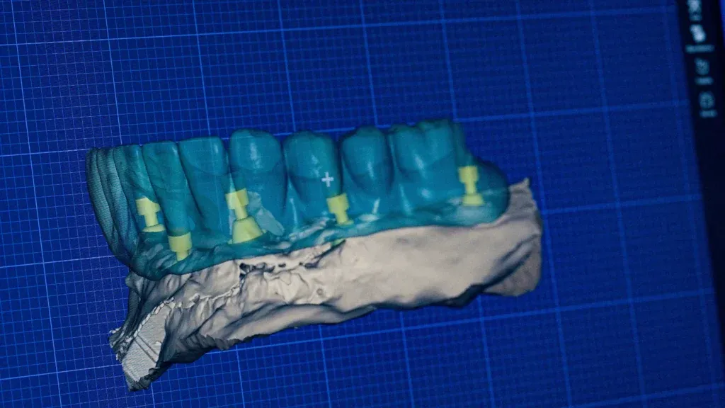 Dental Implant Cost | Boca Raton Clinic | Call (561) 391-6606