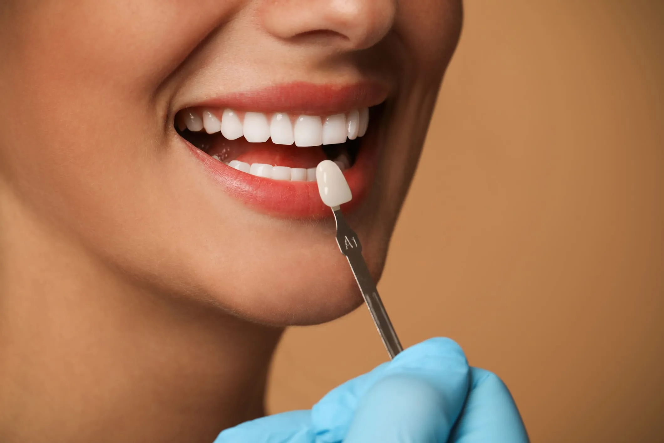 Dental veneers at Boca Dental in Boca Raton, FL